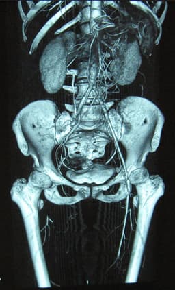 Thromboangiitis obliterans